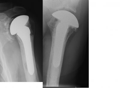 Zimmer Anatomical Shoulder Prosthesis (Implant 19)